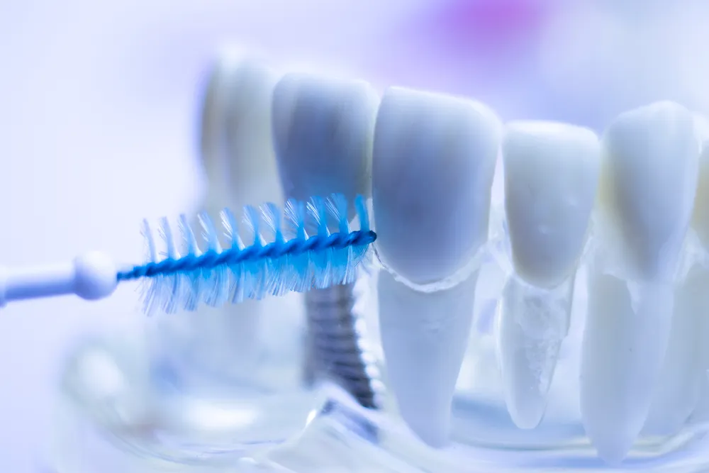 De voordelen van interdentale ragers voor tanden